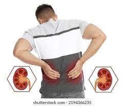Kidney stone